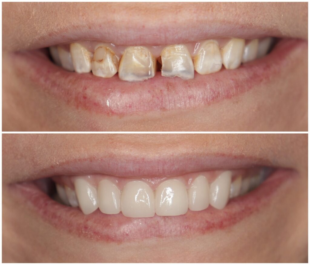 Before and After Image: Porcelain Crowns - front