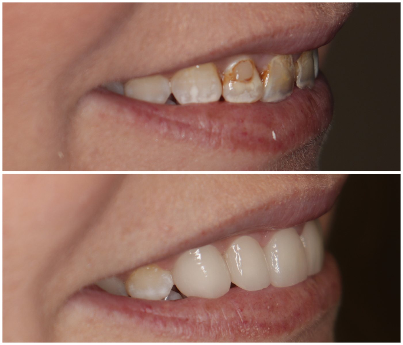 Before and After Image: Porcelain Crowns - right-front-oblique