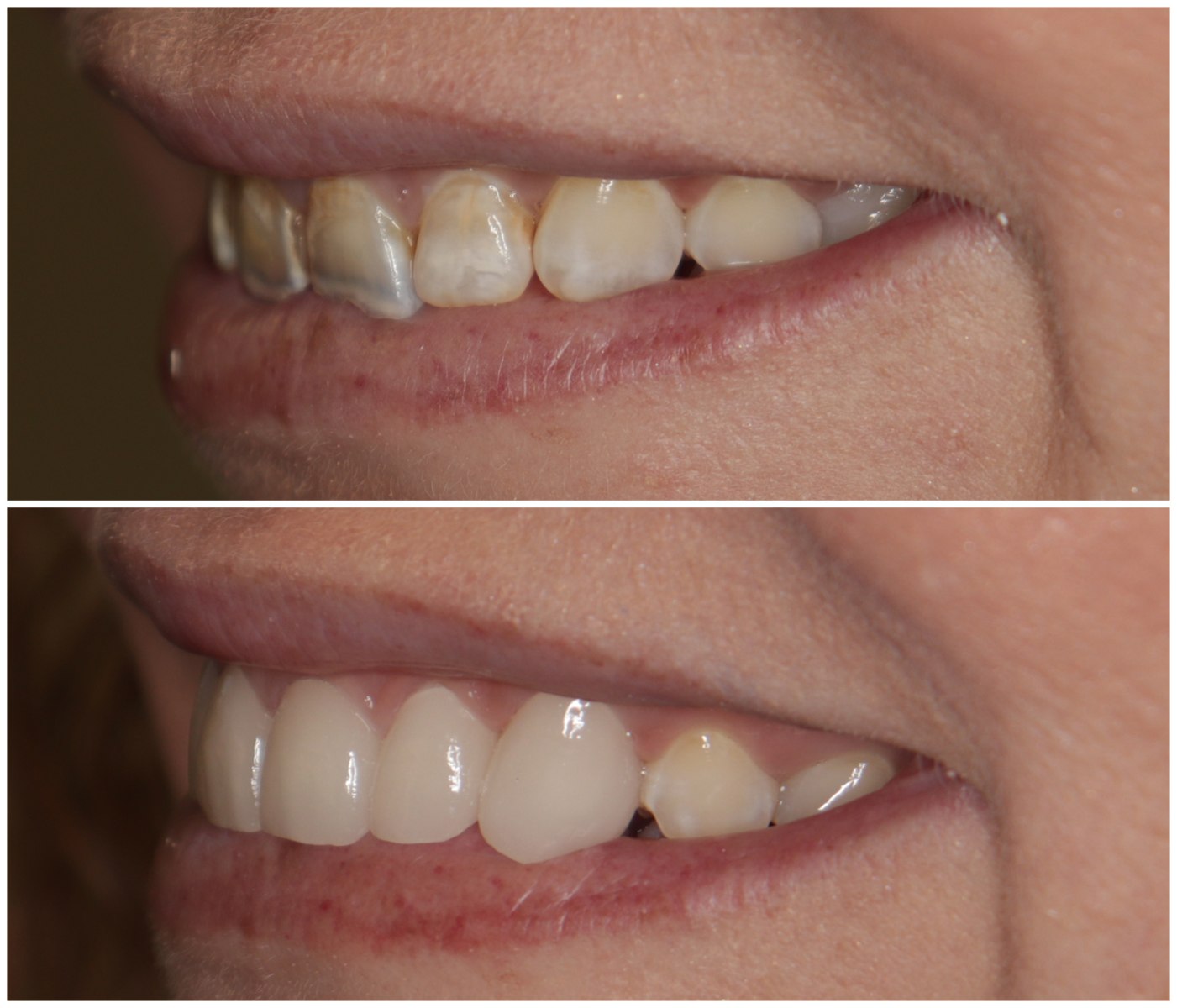 Before and After Image: Porcelain Crowns - left-front-oblique