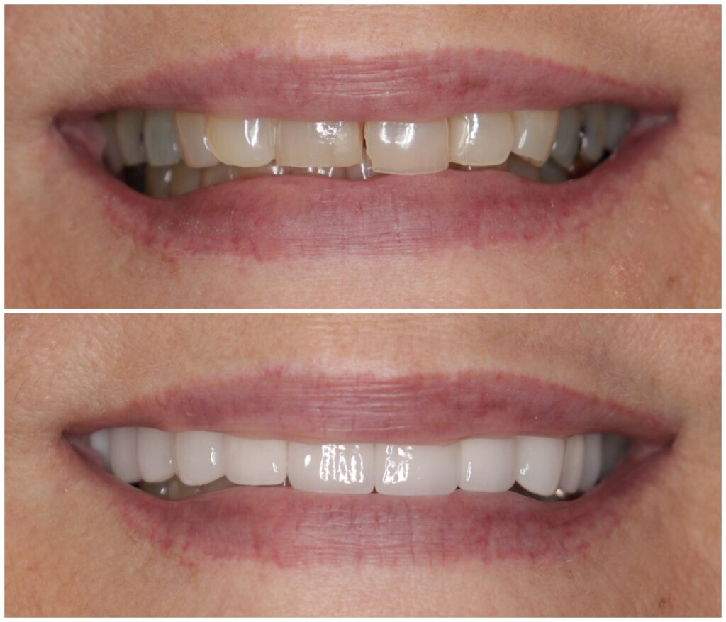 Before and After Image: Porcelain Crowns - front