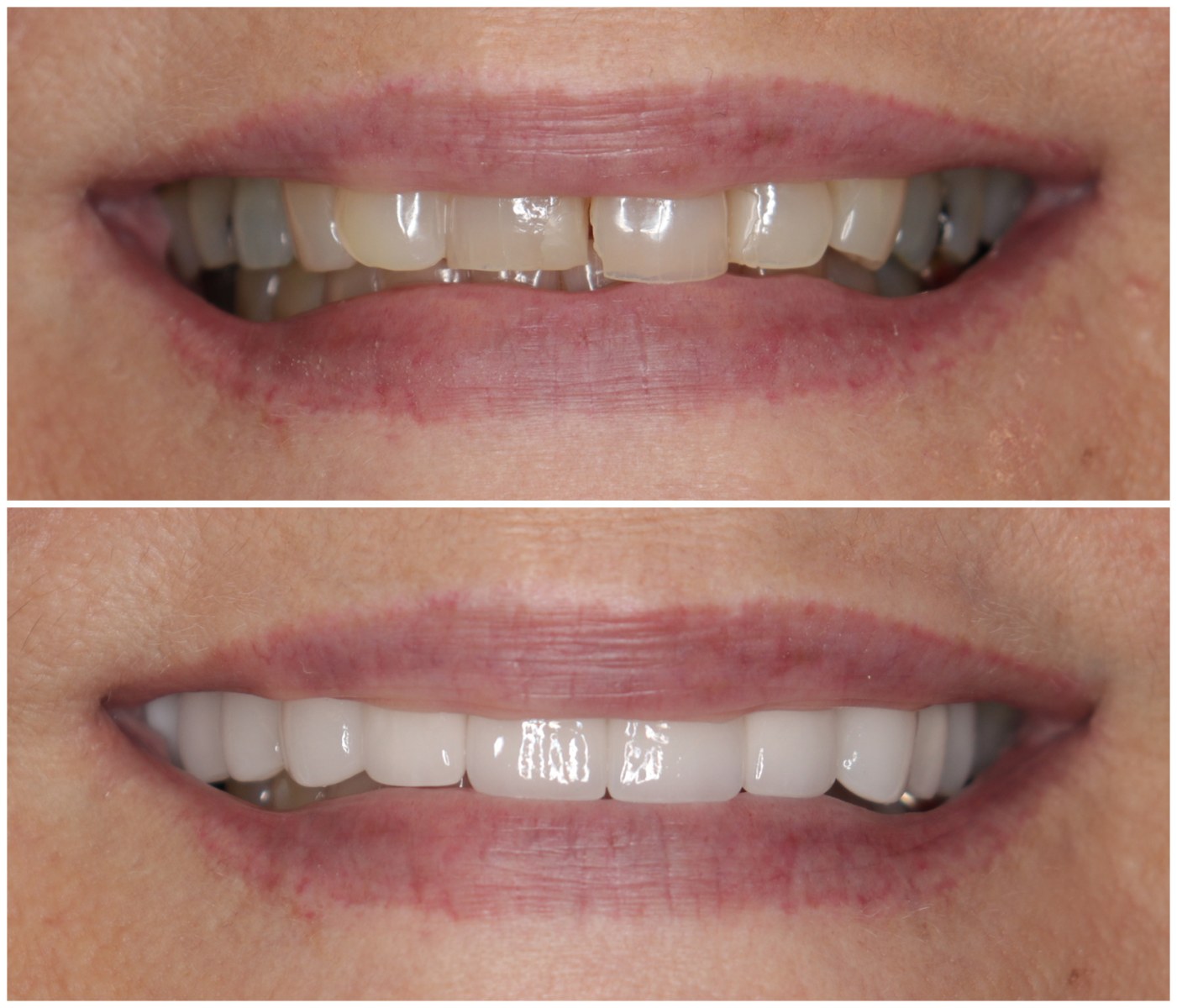 Before and After Image: Porcelain Crowns - front