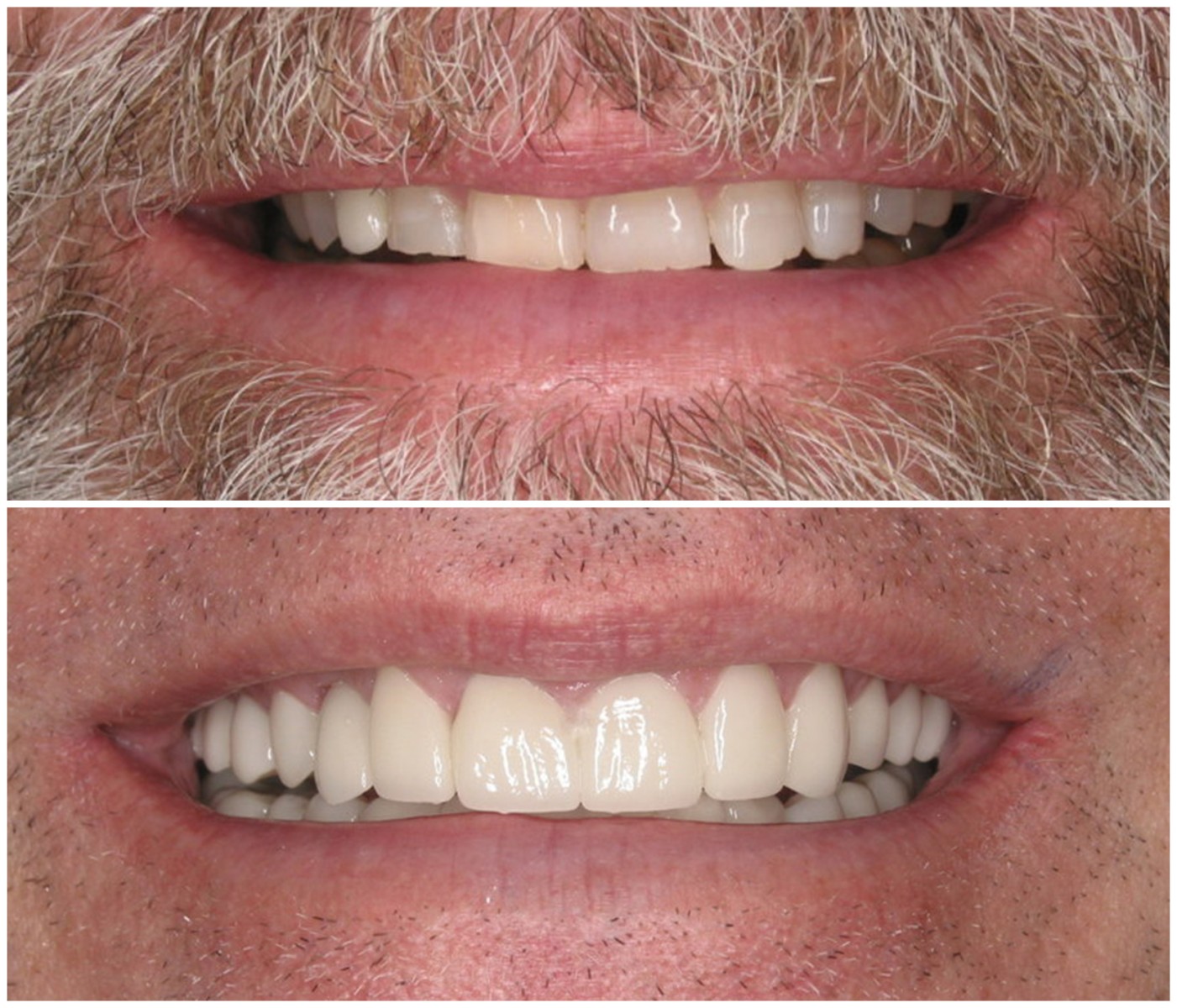 Before and After Image: Porcelain Crowns - front