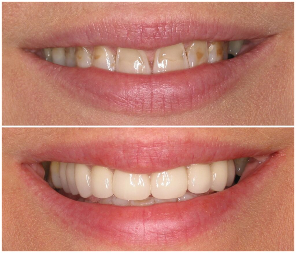 Before and After Image: Porcelain Crowns - front