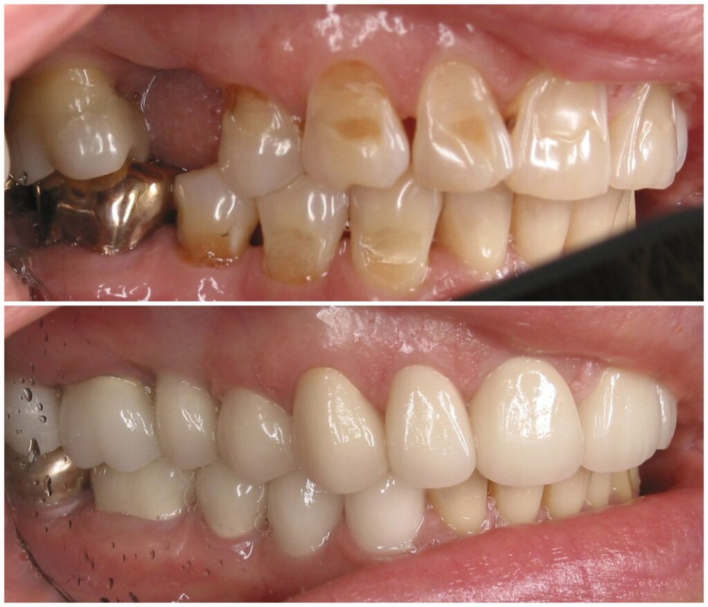 Before and After Image: Porcelain Crowns - right-front-oblique