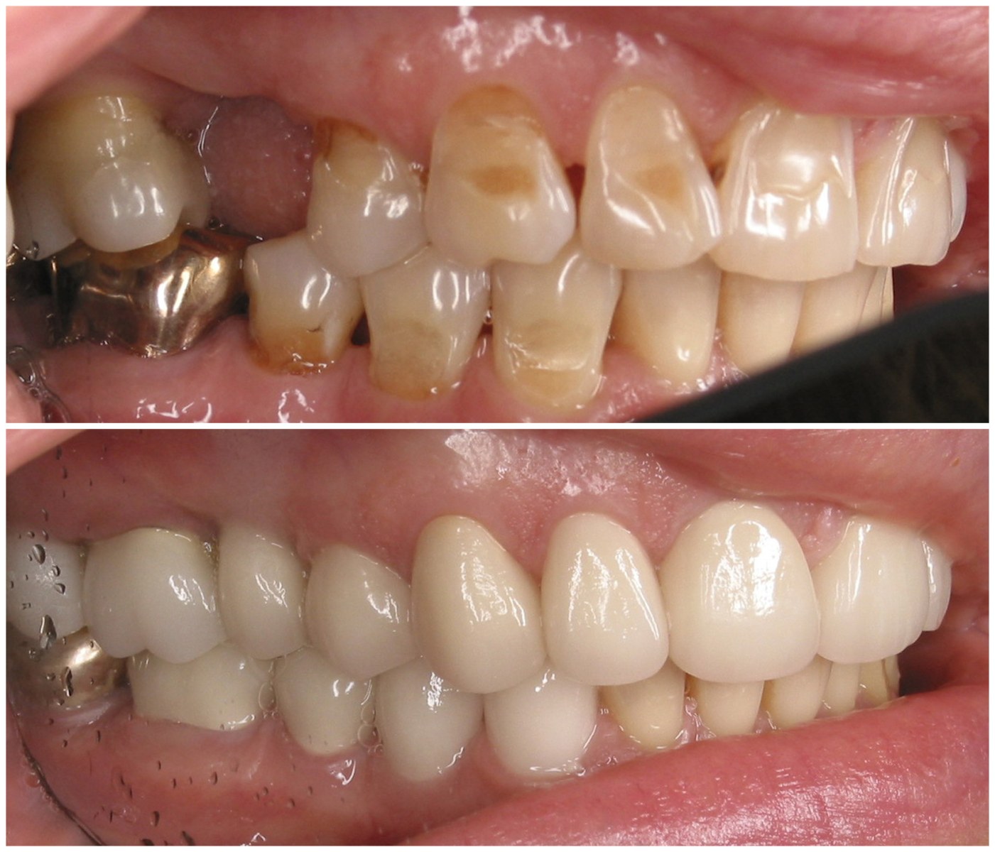 Before and After Image: Porcelain Crowns - right-front-oblique