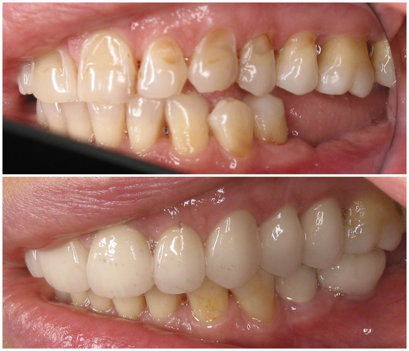 Before and After Image: Porcelain Crowns - right-front-oblique