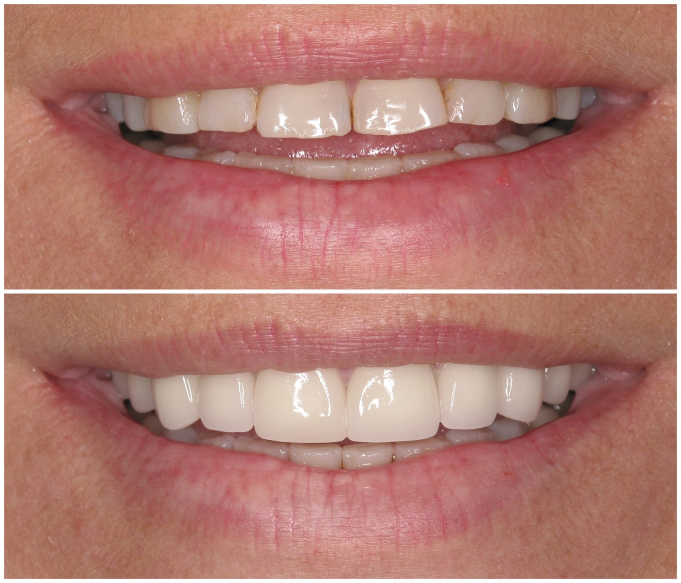 Before and After Image: Porcelain Crowns - front