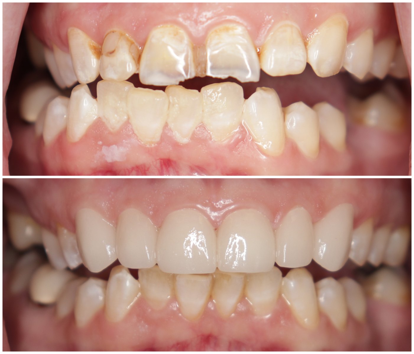 Before and After Image: Porcelain Crowns - front
