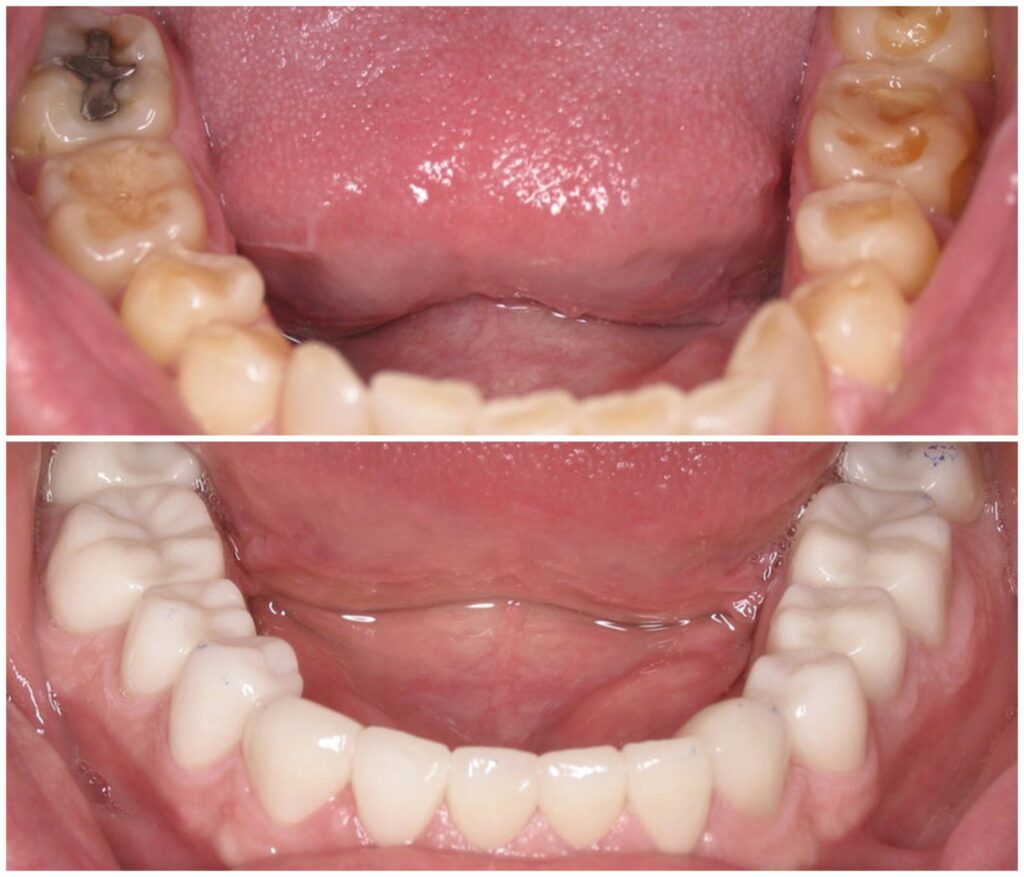 Before and After Image: Porcelain Crowns - front