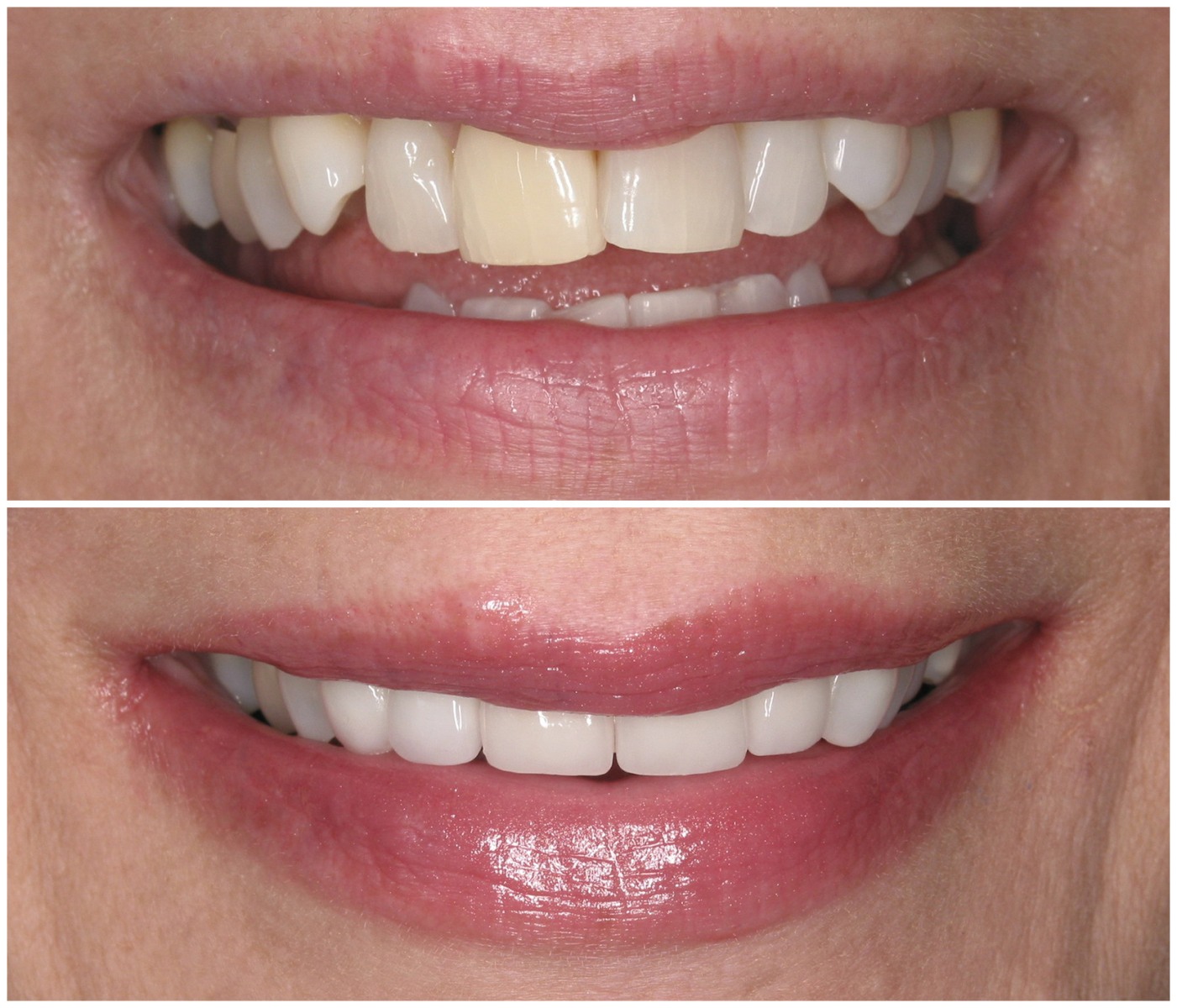 Before and After Image: Porcelain Crowns - front