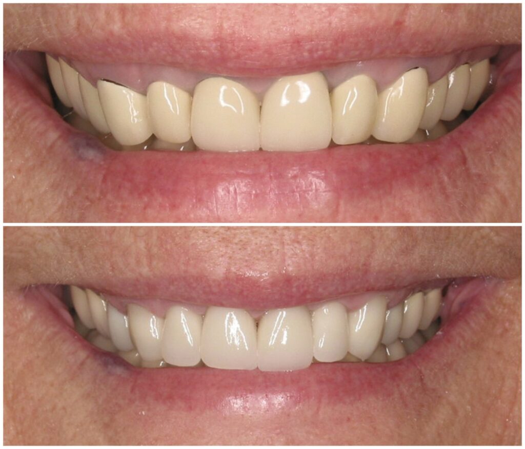 Before and After Image: Porcelain Crowns - front