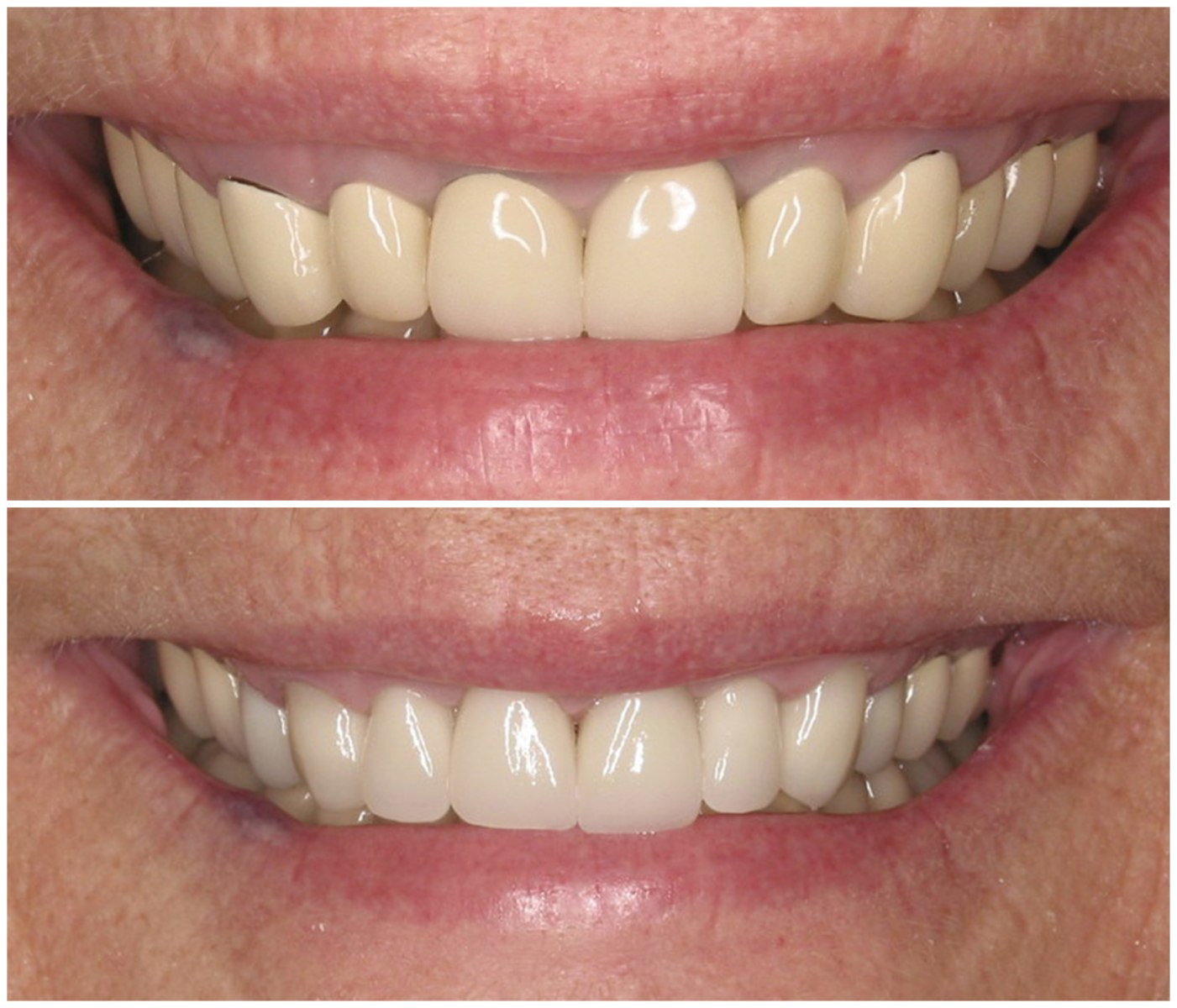 Before and After Image: Porcelain Crowns - front