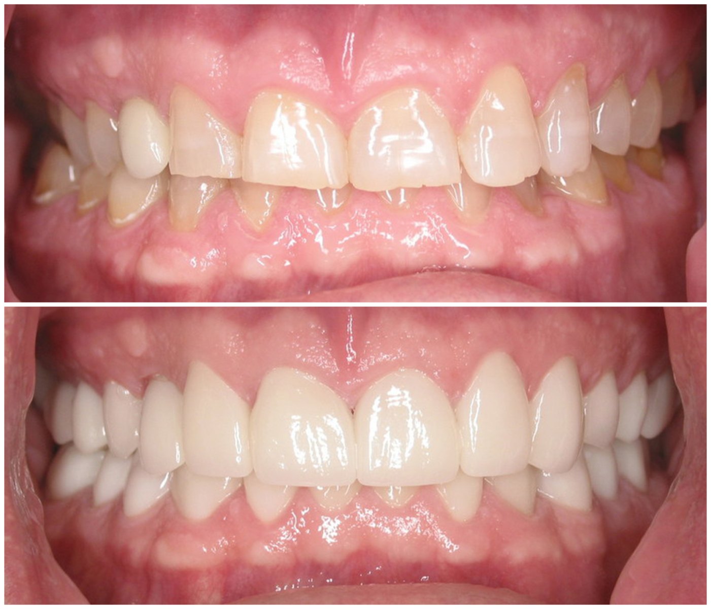 Before and After Image: Porcelain Crowns - front