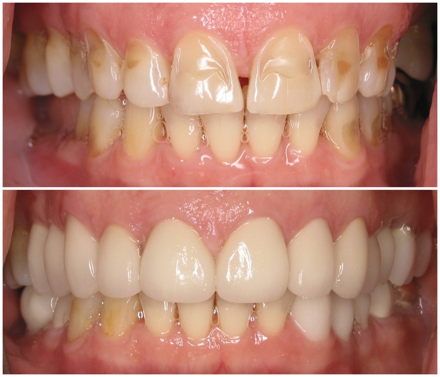 Before and After Image: Porcelain Crowns - front
