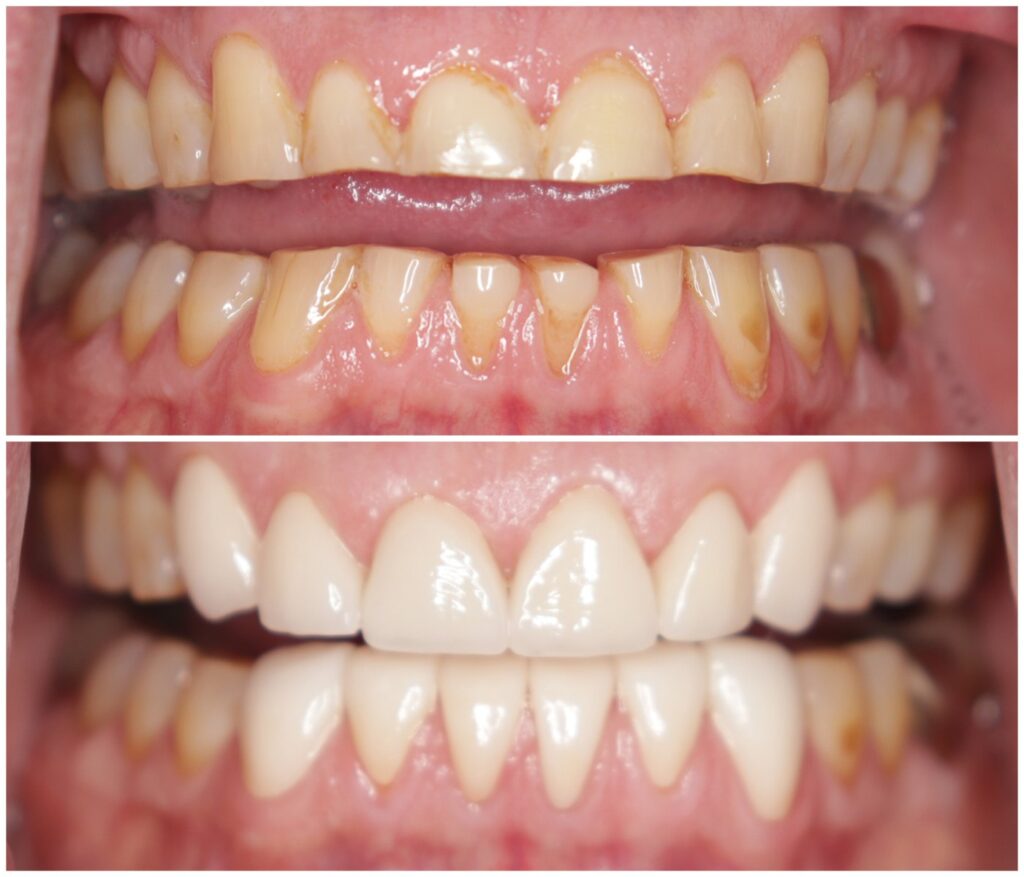 Before and After Image: Porcelain Crowns - front