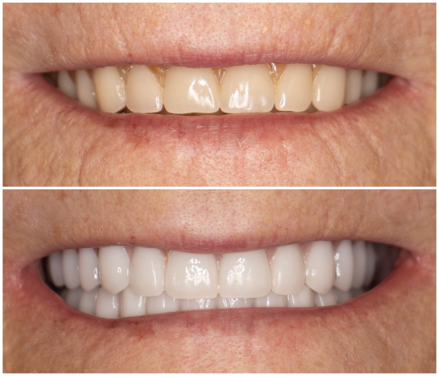 Before and After Image: Dentures - front