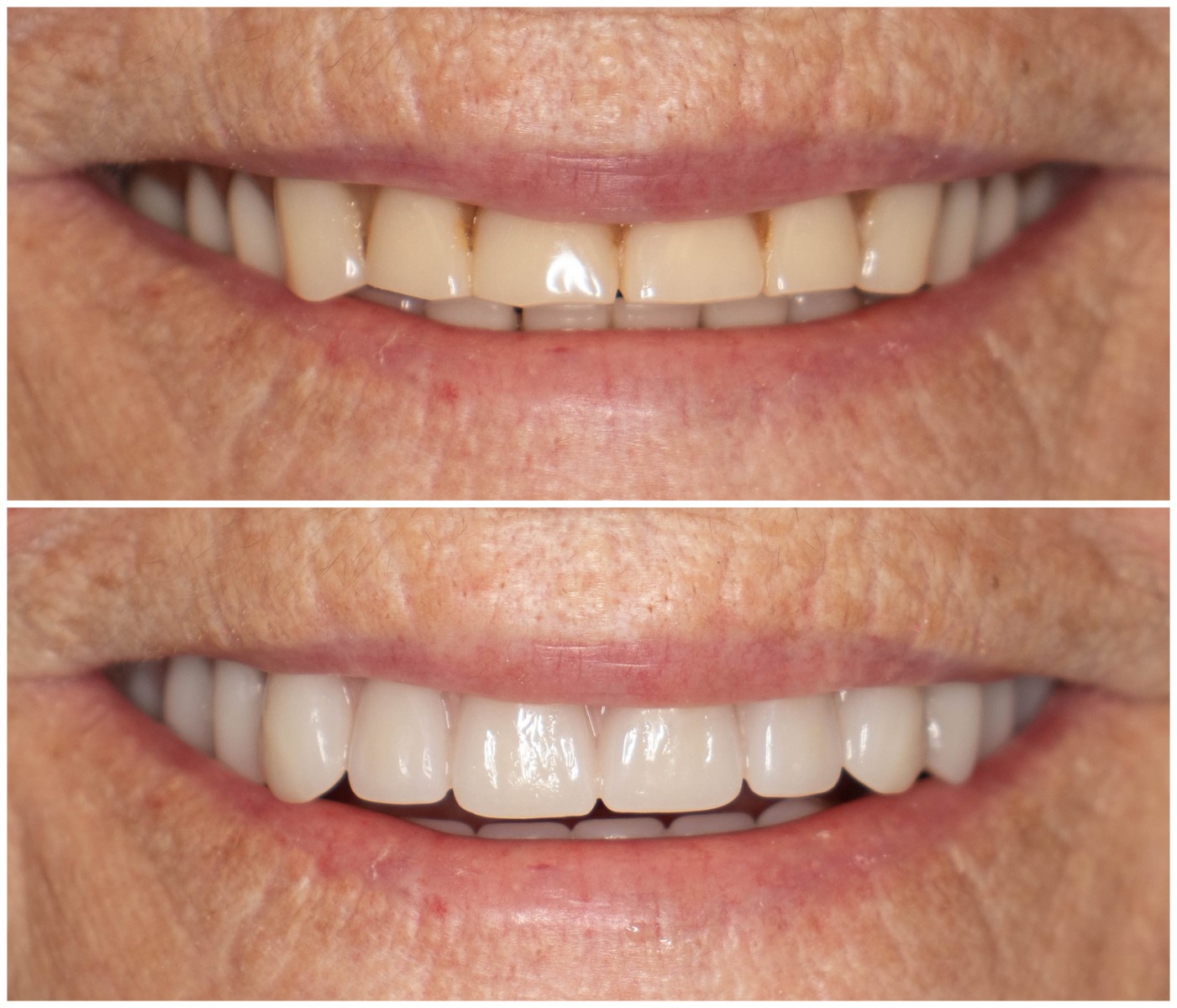 Before and After Image: Dentures - front