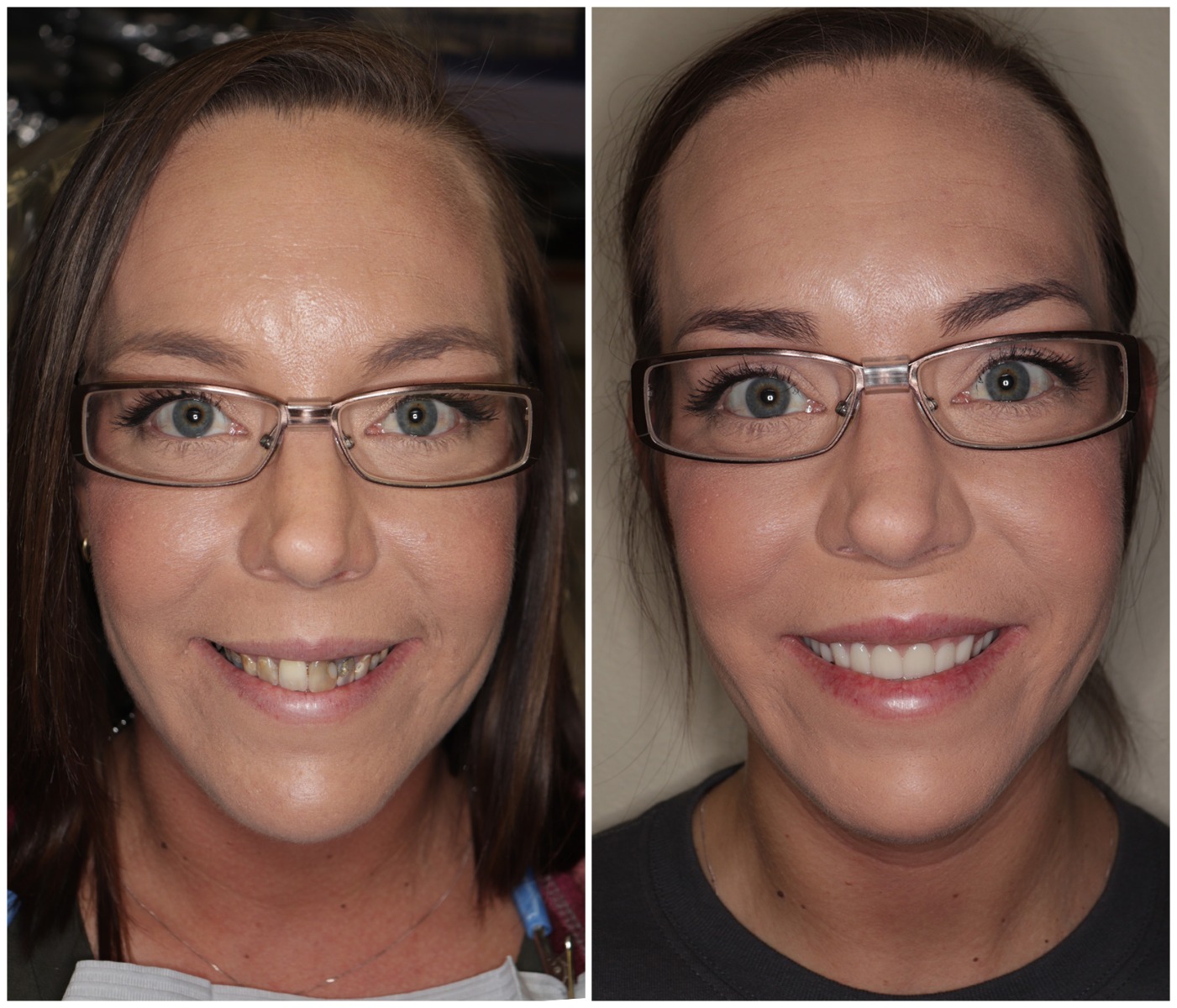 Before and After Image: Dentures - front