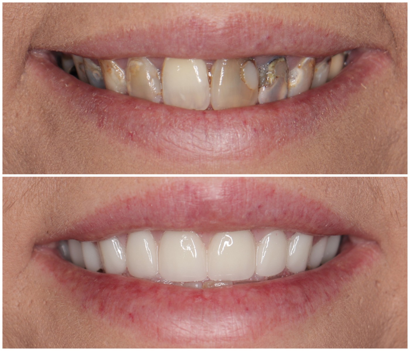 Before and After Image: Dentures - front
