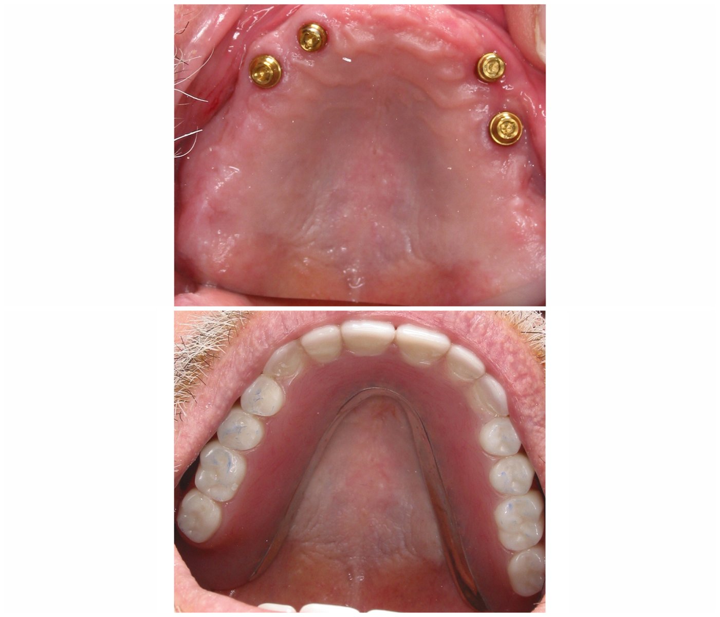 Before and After Image: Dentures - front