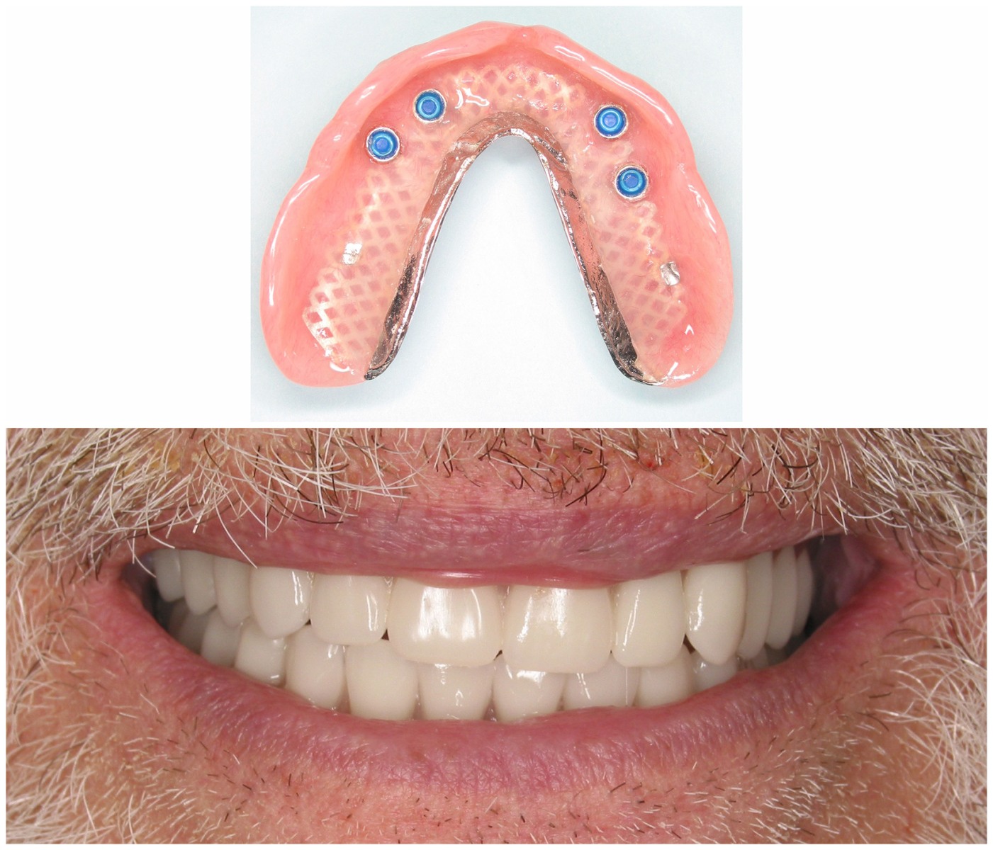 Before and After Image: Dentures - front