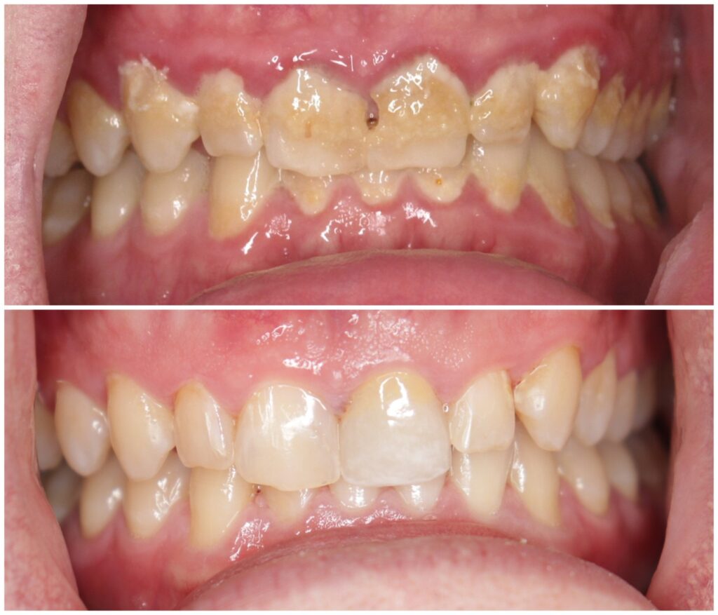 Before and After Image: Gum Therapy - front