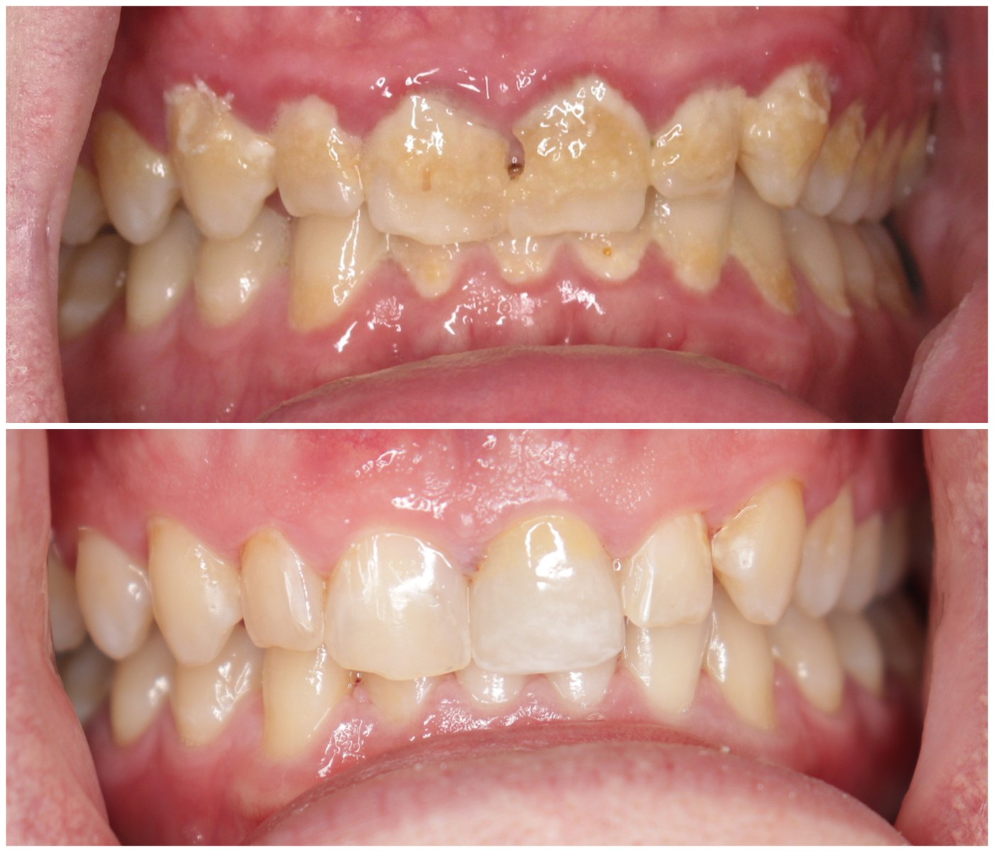 Before and After Image: Gum Therapy - front
