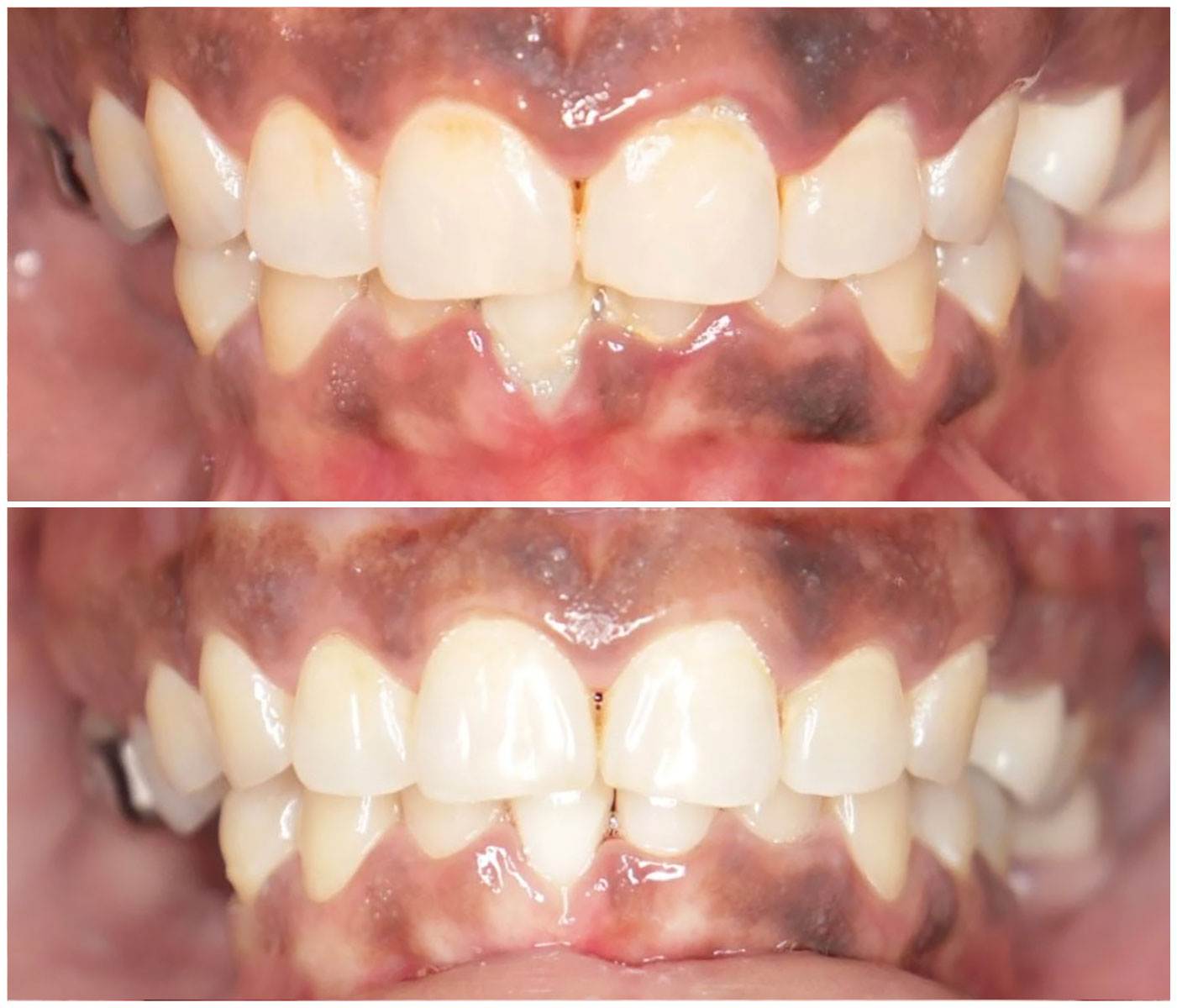 Before and After Image: Gum Therapy - front