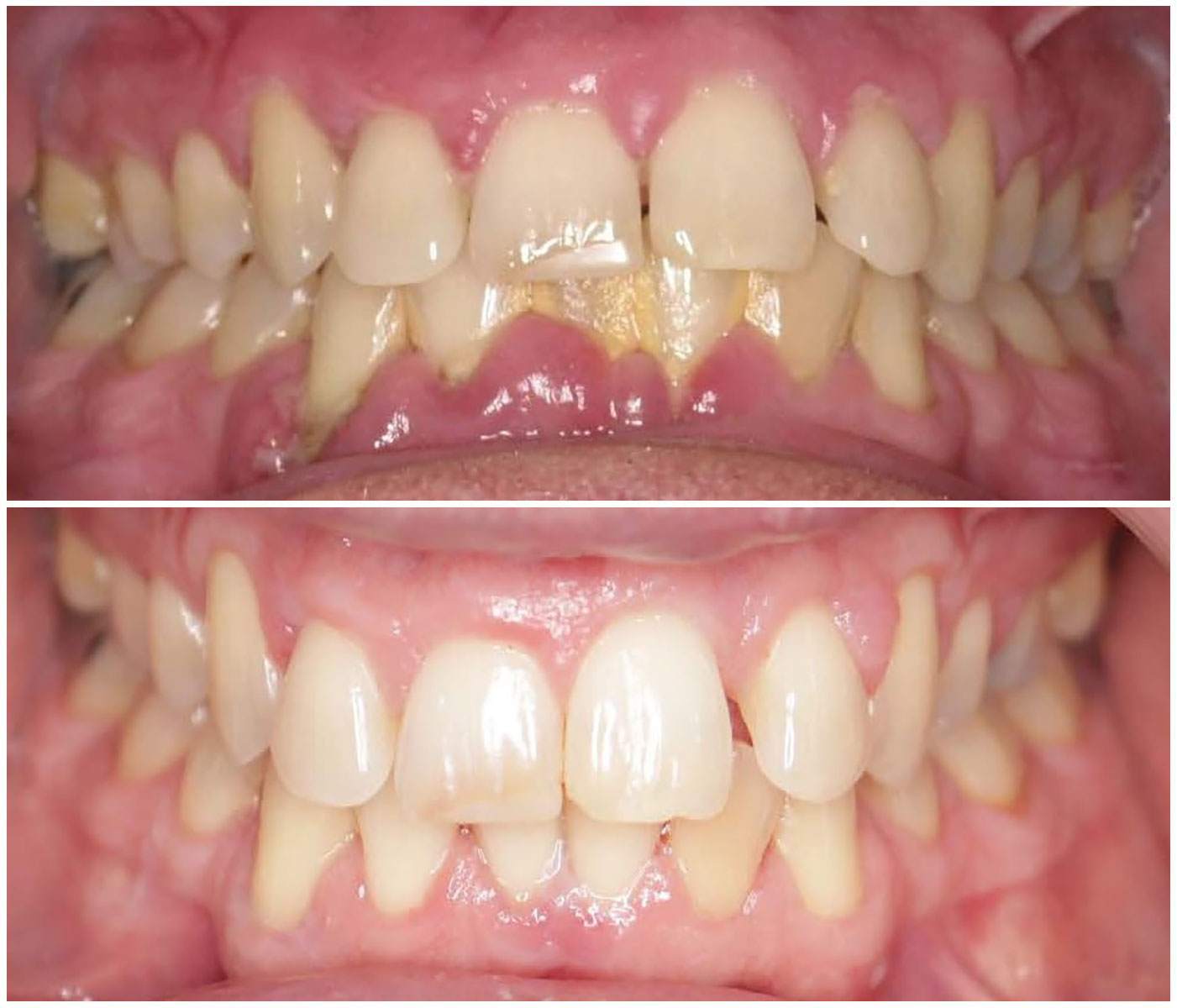Before and After Image: Gum Therapy - front