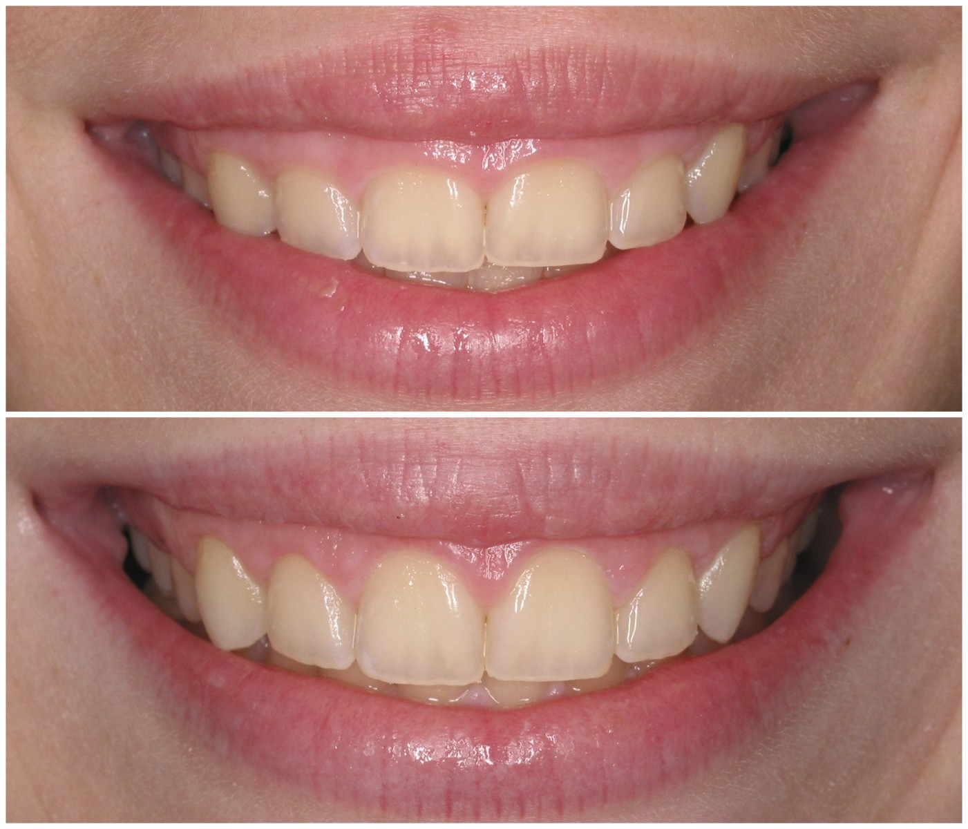 Before and After Image: Gingival Re-Contouring - front