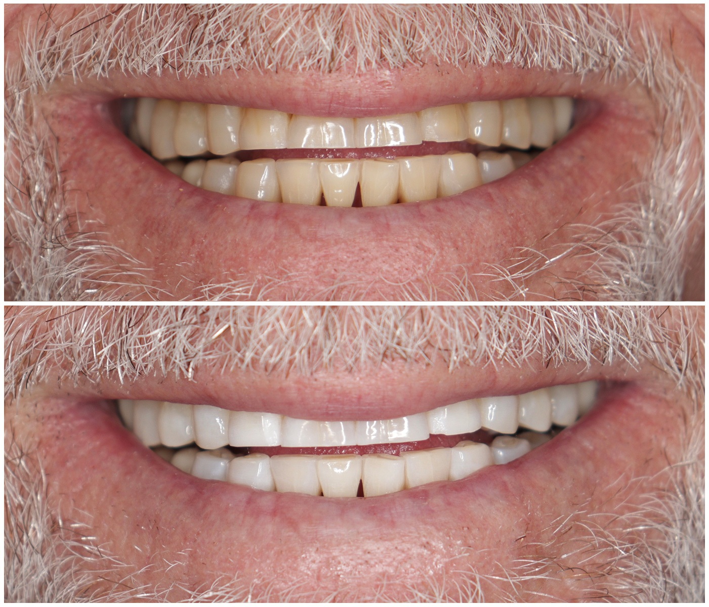 Before and After Image: Teeth Whitening - front