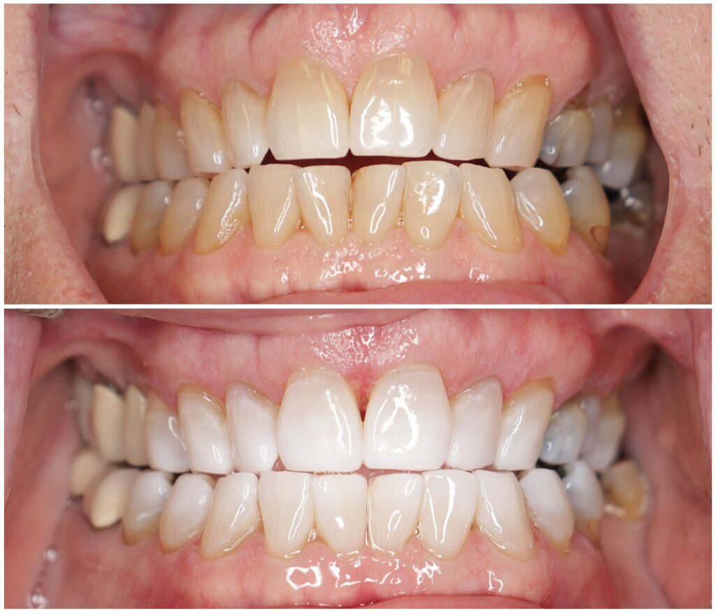 Before and After Image: Teeth Whitening - front