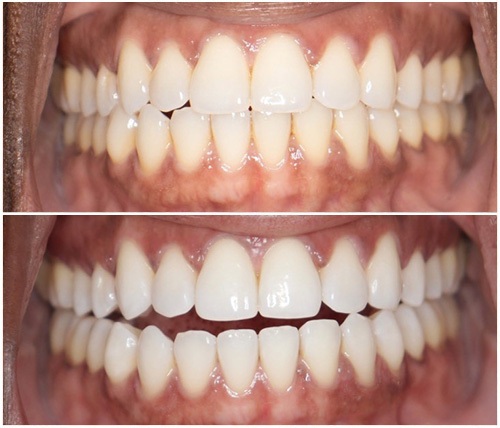 Before and After Image: Teeth Whitening - front