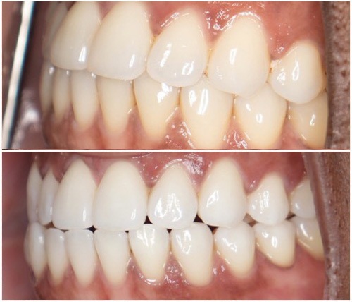 Before and After Image: Teeth Whitening - left-front-oblique