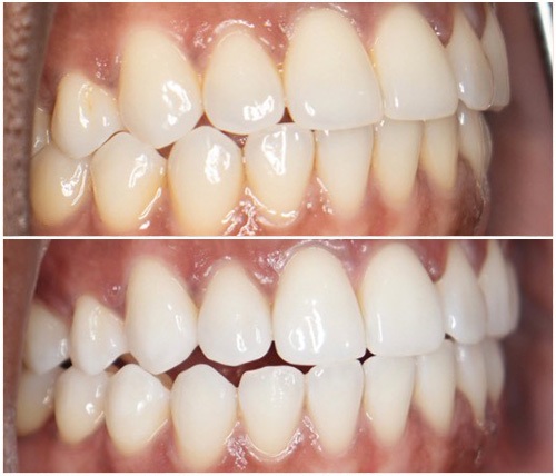 Before and After Image: Teeth Whitening - right-front-oblique
