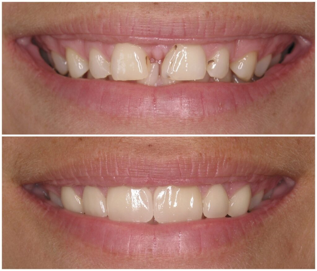 Before and After Image: Porcelain Veneers - front