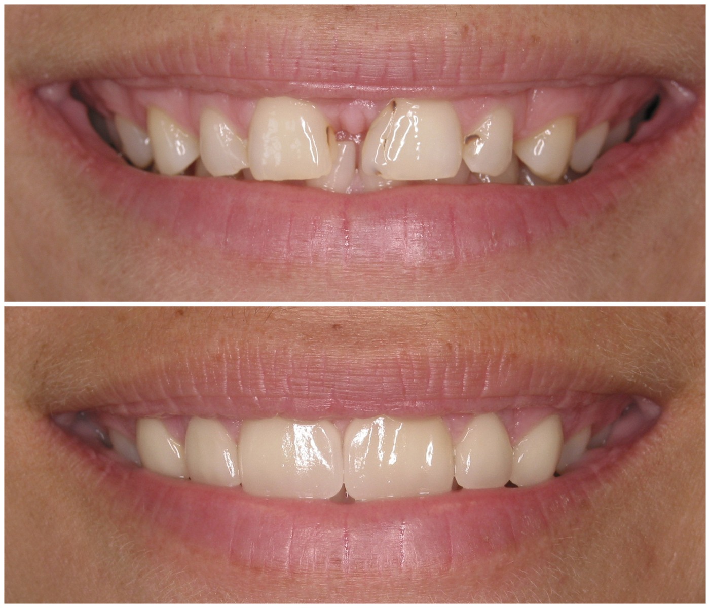 Before and After Image: Porcelain Veneers - front