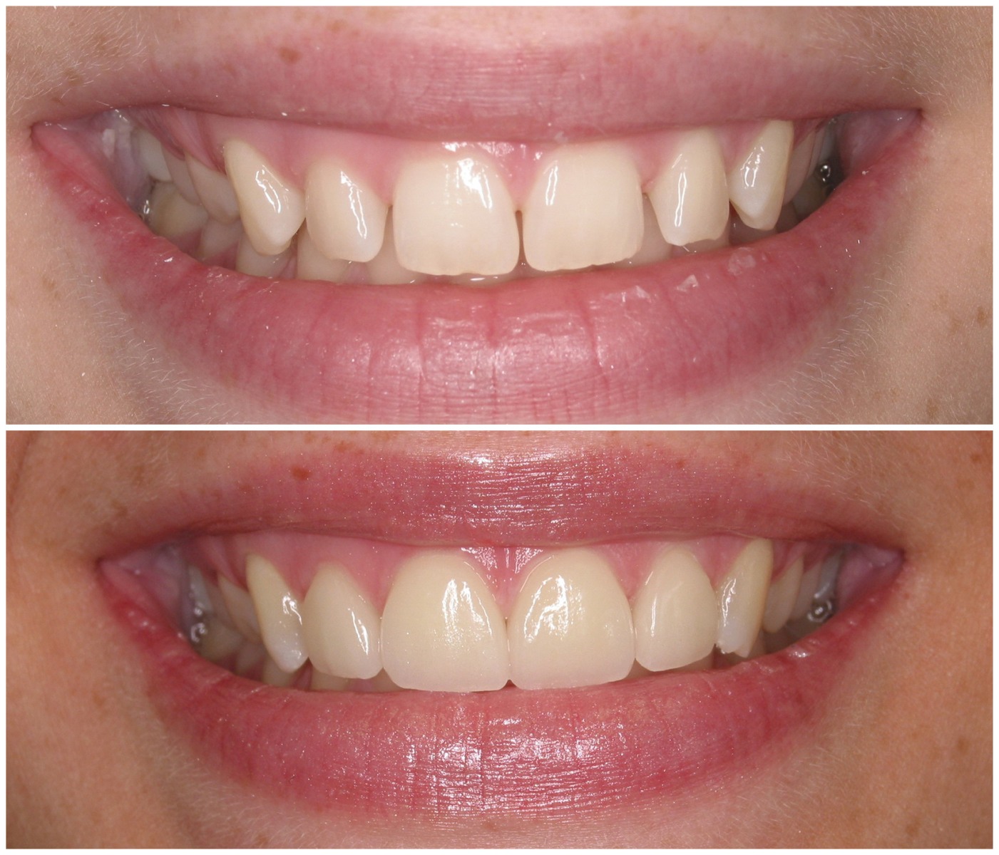 Before and After Image: Porcelain Veneers - front