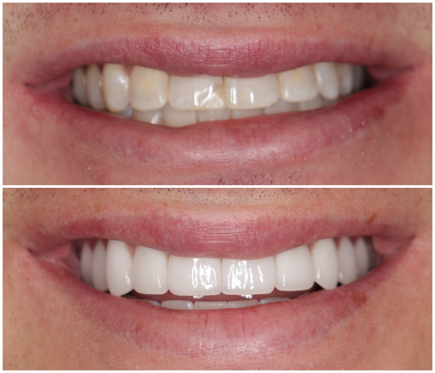 Before and After Image: Porcelain Veneers - front