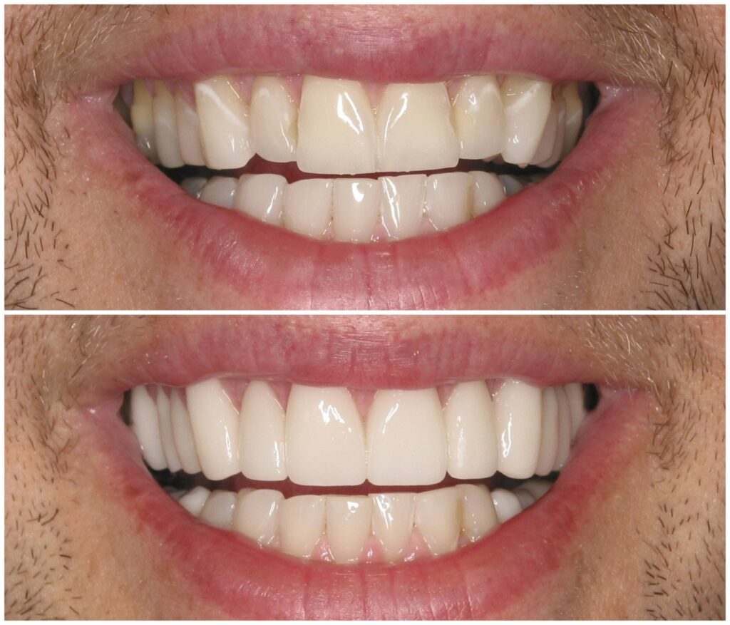 Before and After Image: Porcelain Veneers - front
