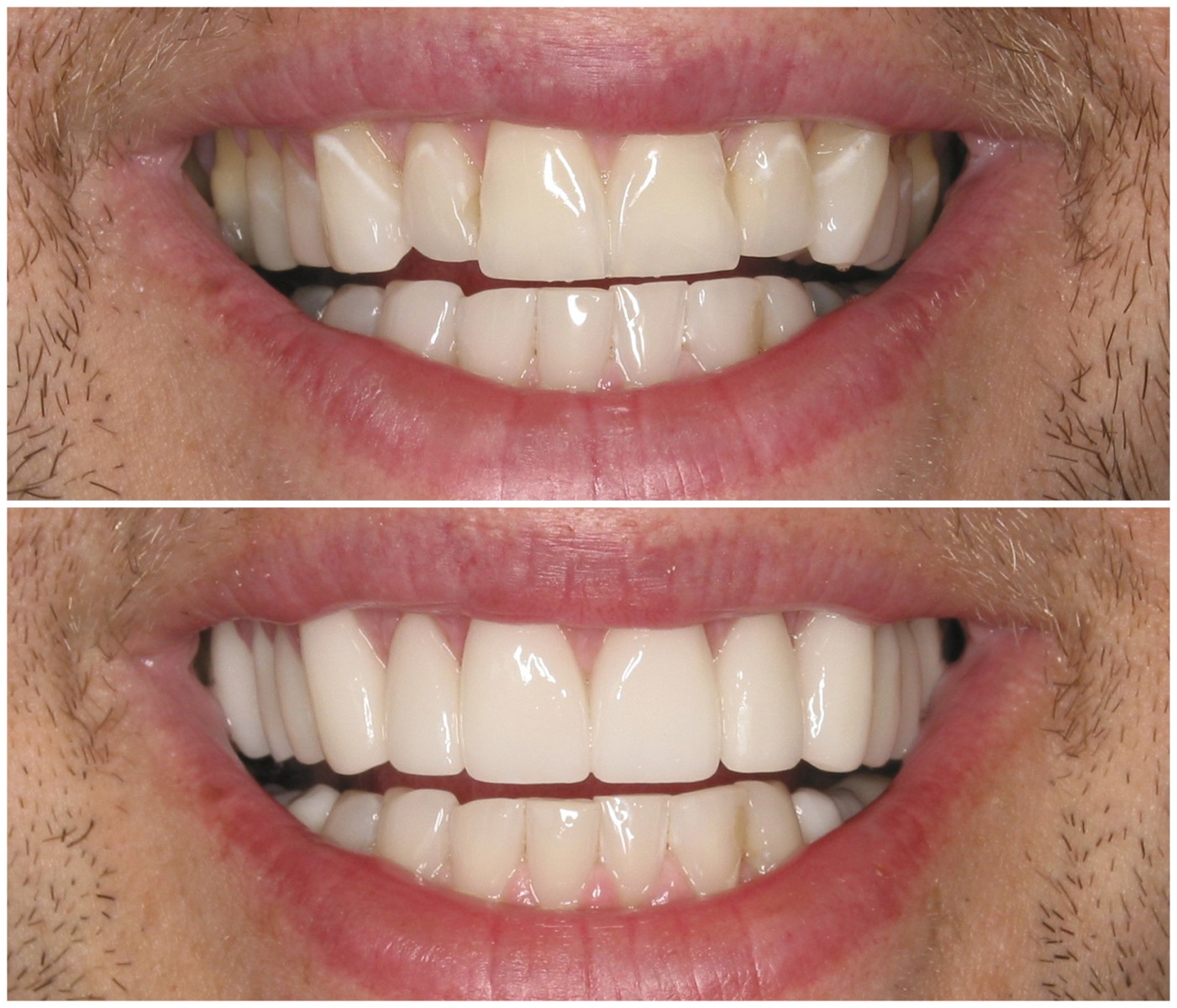 Before and After Image: Porcelain Veneers - front