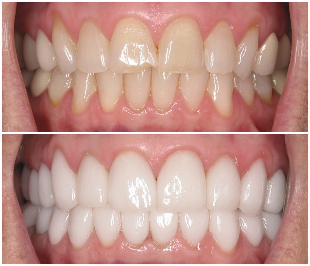 Before and After Image: Porcelain Veneers - front