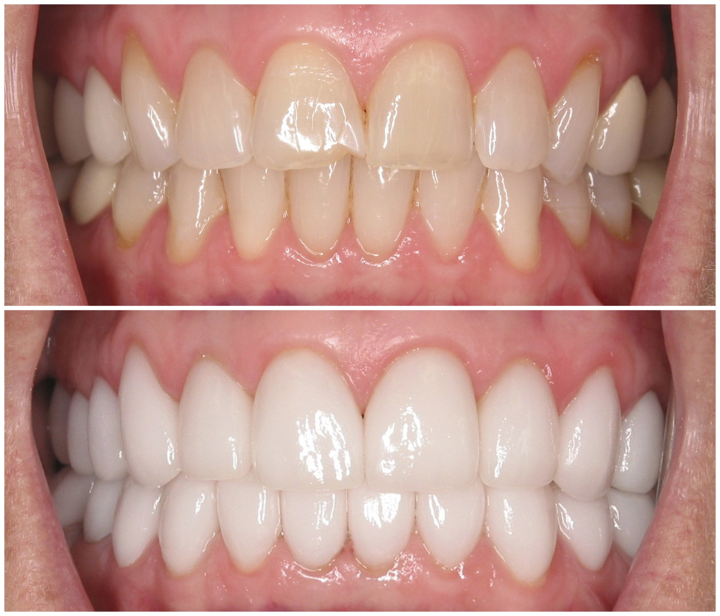 Before and After Image: Porcelain Veneers - front