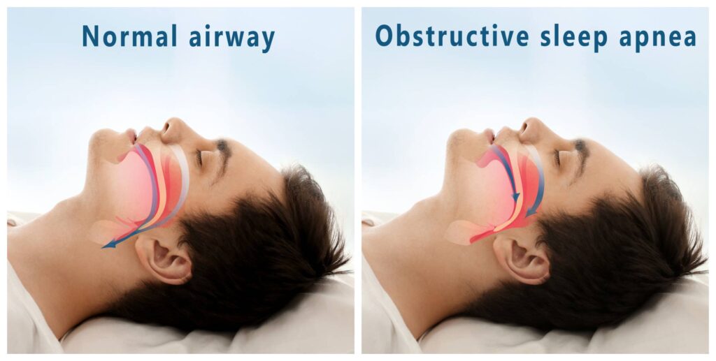 Side by side images of a normal airway and one affected by obstructive sleep apnea (OSA)