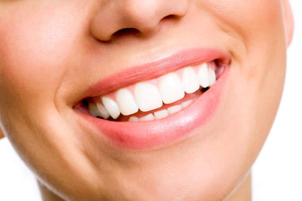 Close-up image of a woman's beautiful smile after veneers and orthodontics in Hot Springs