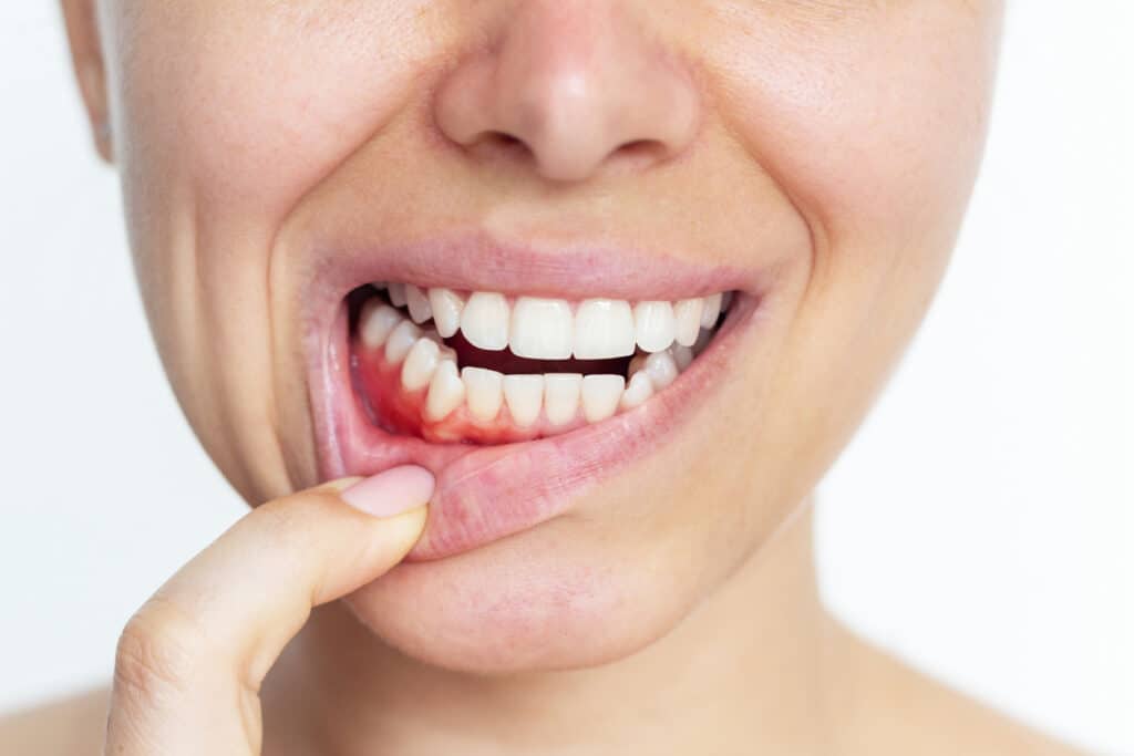 Close up of a patient showing her enflamed gums from potential gum disease and in need of periodontal treatment.