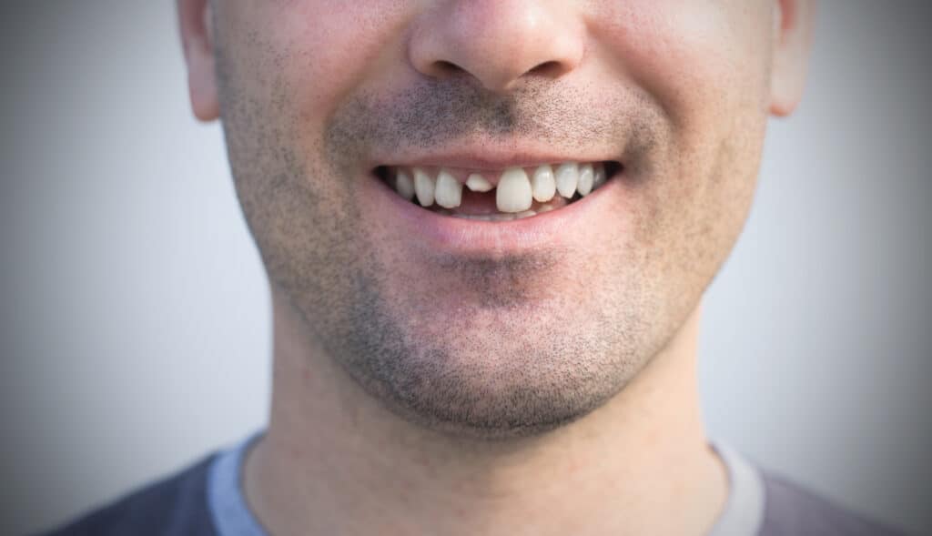 Close-up of a smiling man who has broken his front tooth and needs emergency dental treatment without delay.