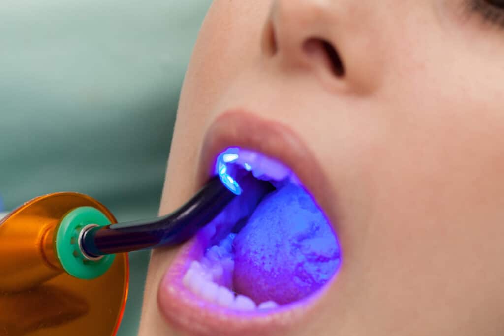 Dentist,Working,With,Dental,Polymerization,Lamp,In,Oral,Cavity. Close up of a patients mouth getting their new dental fillings cured with the specialized UV light